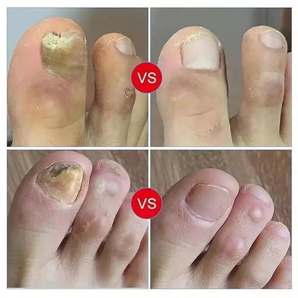 Nail Fungal Treatment Serum Foot Toe Nail Fungus Removal Essential Oil Anti Infection Onychomycosis Paronychia Repairing Care