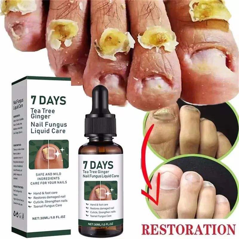 Fungal Nail Treatment Serum 7 Days Fungus Removal Treating Paronychia Liquid Anti Gray Nails Infection Foot Repair Care Tools