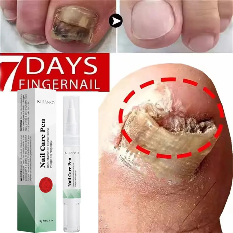 Nail Fungal Treatment Serum Foot Toe Nail Fungus Removal Essential Oil Anti Infection Onychomycosis Paronychia Repairing Care