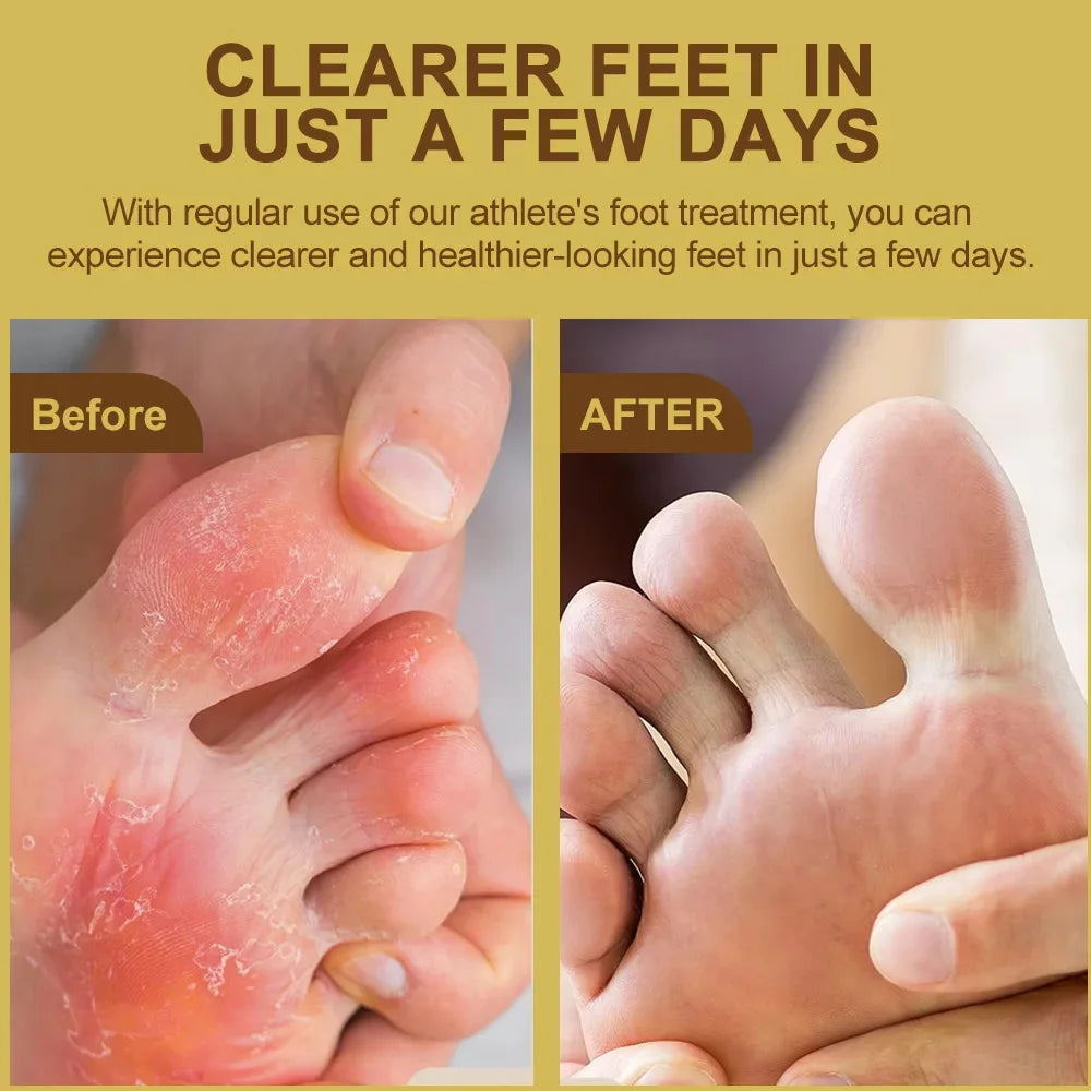 Anti-Foot Fungus Ointment Deodorant Care Products Foot Deodorant Creams Antiseptic and Antiperspirant Foot Skin Topical Cream